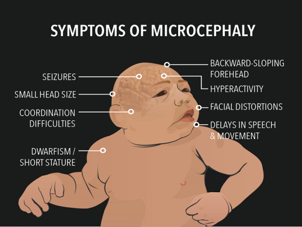 microcephaly